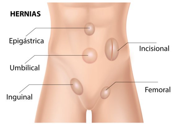 hernias abdominales – Proctología RD hernias abdominales | Proctóloga Santo Domingo